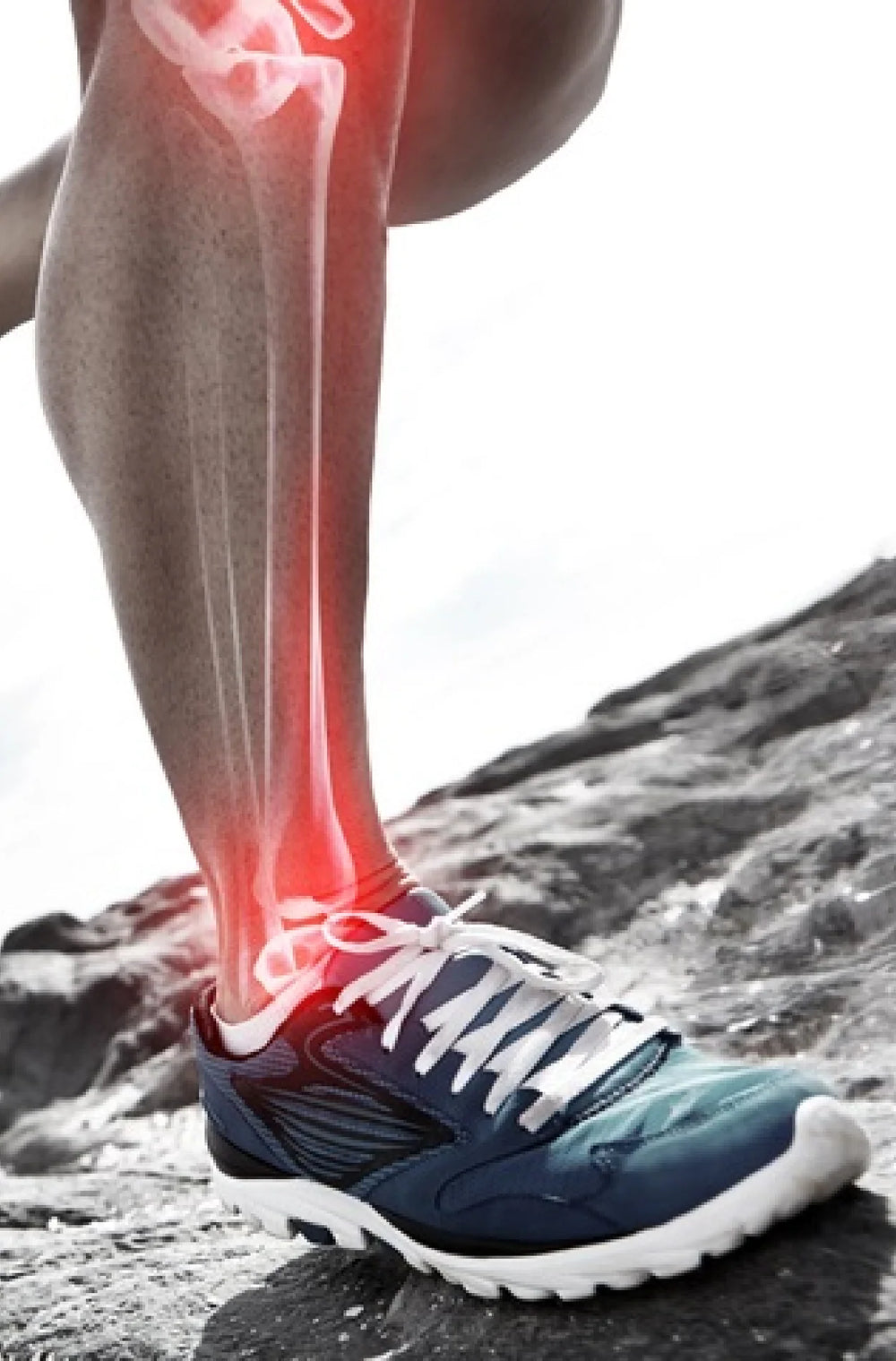 Shin Splints